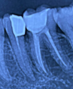 عکسی از توصیه بعد از درمان زیشه